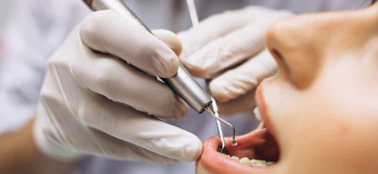 Porcelain-Veneers