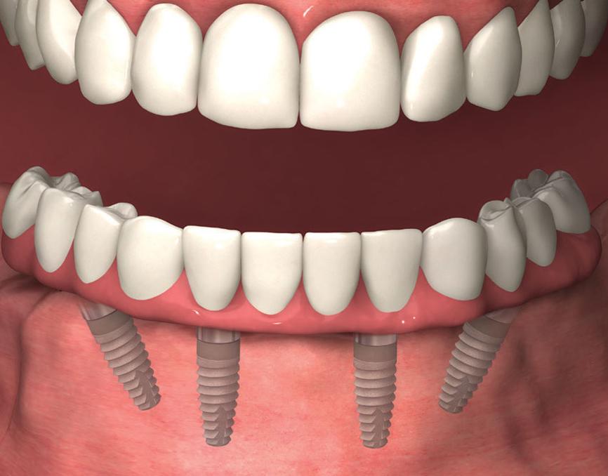 Dental implants done by Dr Li Chen