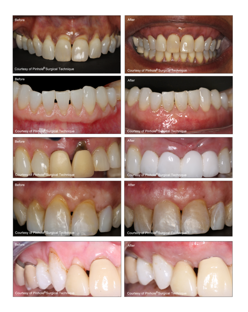 Pinhole Gum Rejuvenation - Dr Chen